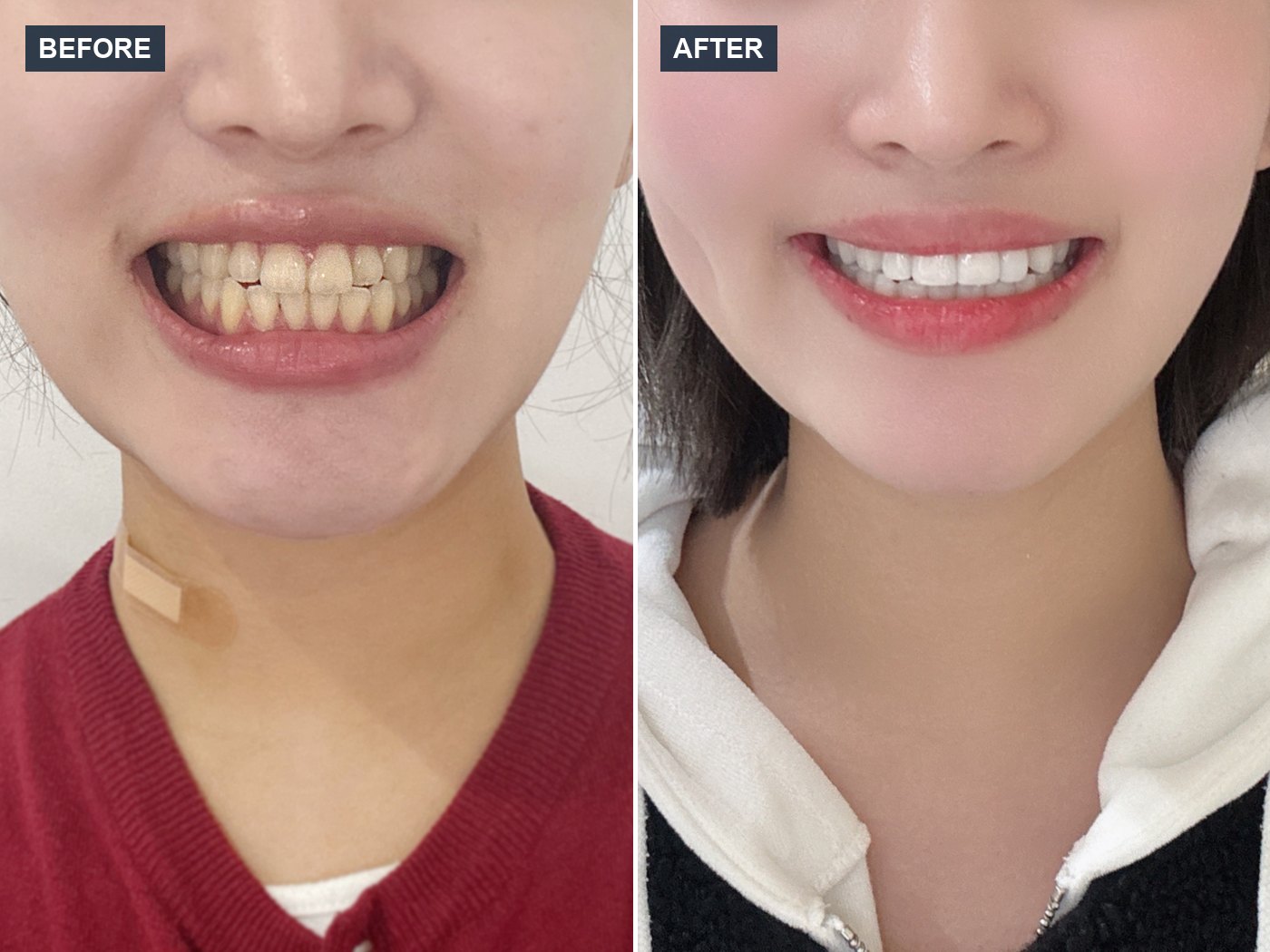 韓国 ラミネートベニア 審美歯科 症例 Before & After — Case 01