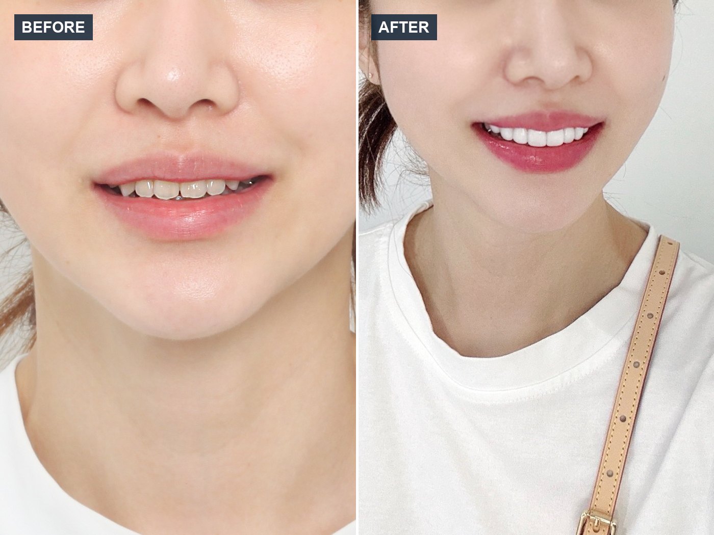 韓国 ラミネートベニア 審美歯科 症例 Before & After — Case 05
