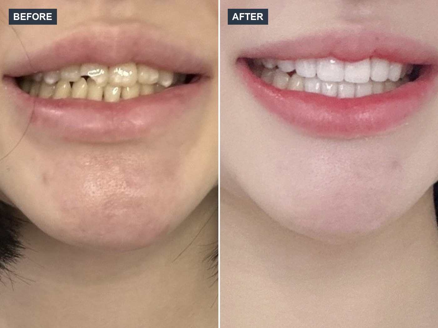 韓国 ラミネートベニア 審美歯科 症例 Before & After — Case 06